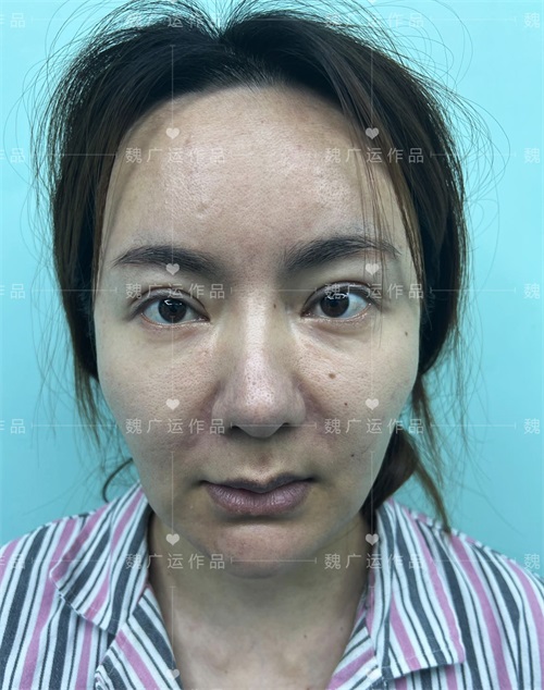 广运拉皮手术案例分享