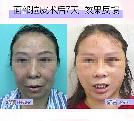 拉皮手术后7天照片