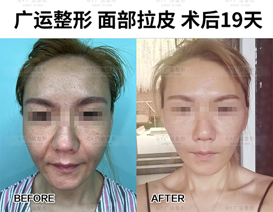 拉皮手术好不好