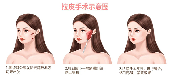 大拉皮手术怎么做？