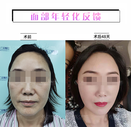 拉皮手术后的真实面部