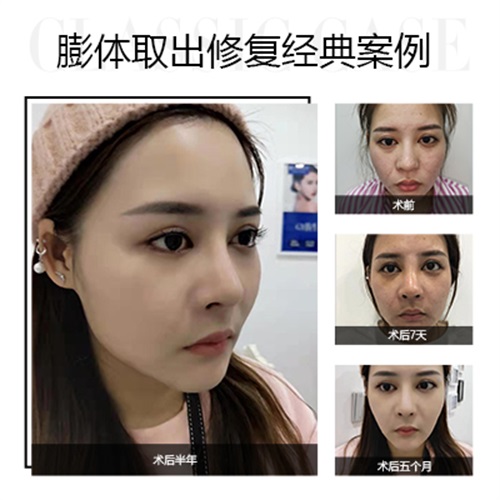 拉皮修复为什么要间隔半年