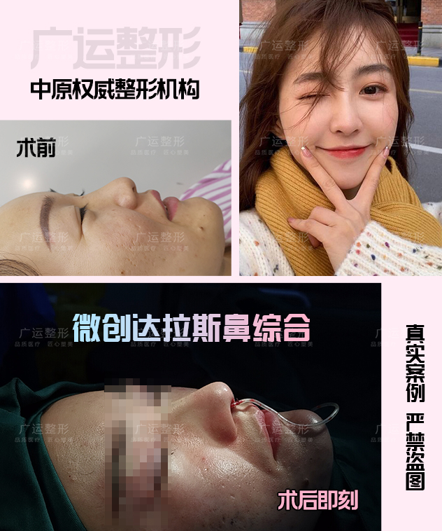 鼻子整容前后照片