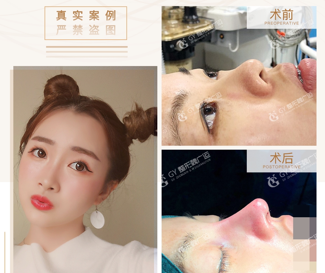 河南广运鼻部整形贵不贵