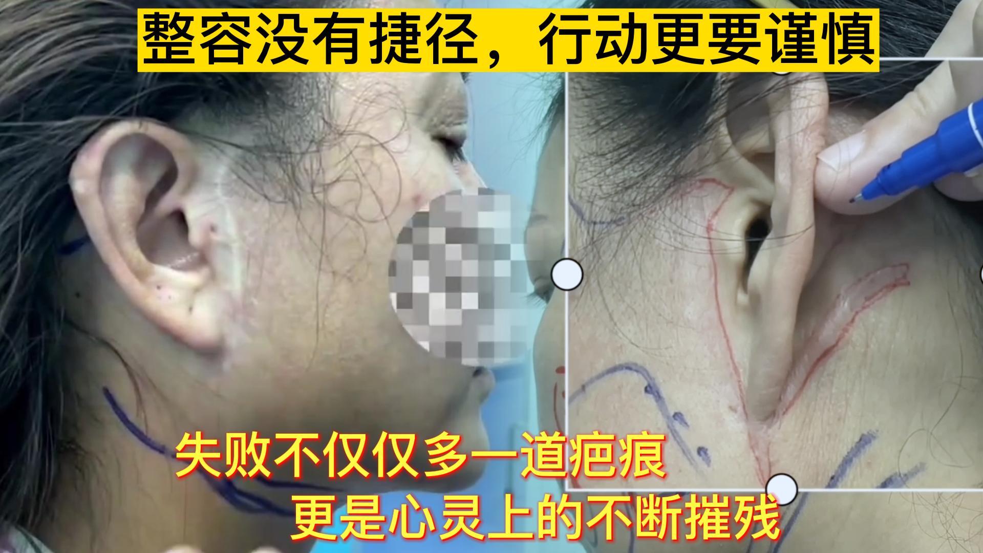 面部拉皮治疗费用